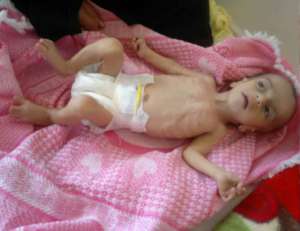 Poważnie niedożywiona 8-miesięczna dziewczynka, szpital w Sanie/flickr.com/CDC Global Takia Yumann